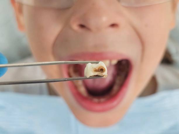Best Emergency Wisdom Teeth Removal in Marion, IA